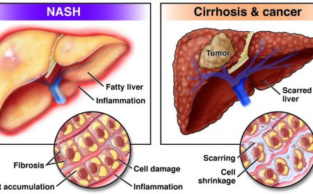 Sciwind's Investigational New Drug Approved for NASH Trial