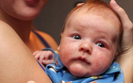 Cow milk protein allergy in children