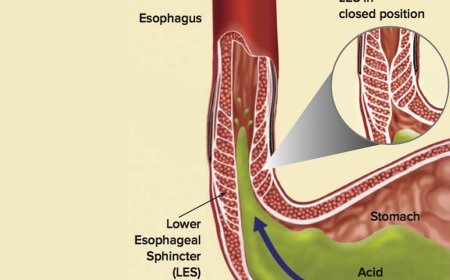 Heartburn after eating causes and prompt treatment