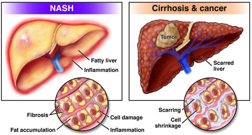 Sciwind's Investigational New Drug Approved for NASH Trial