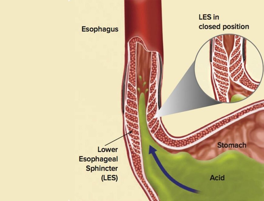 Heartburn after eating causes and prompt treatment