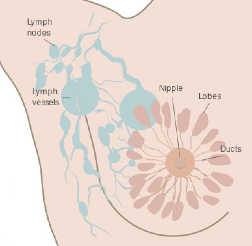 Understanding Stage 0 Breast Cancer: Symptoms, Diagnosis, and Treatment